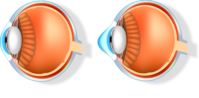 정상각막, 원추각막