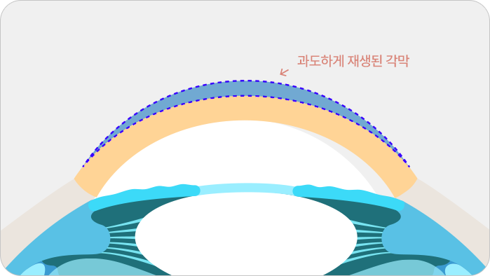 과도하게 재생된 각막