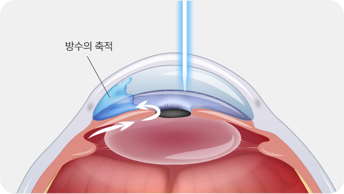 방수의 축적