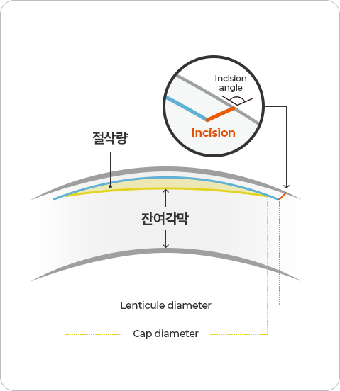 절삭량 ,잔여각막