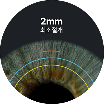 스마트 스마일 안구 회절 보정 이미지